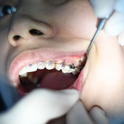 Clindente