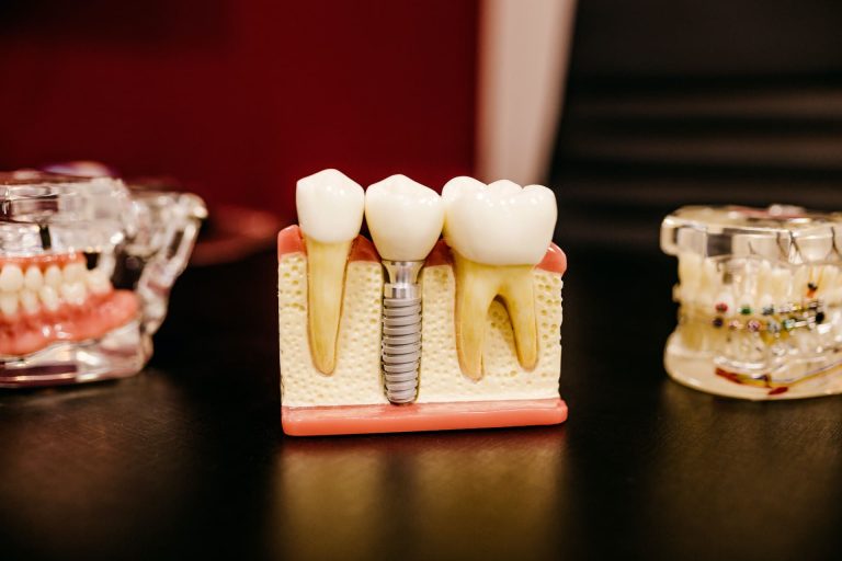 Sorria com Confiança: A Transformação através dos Implantes Dentários